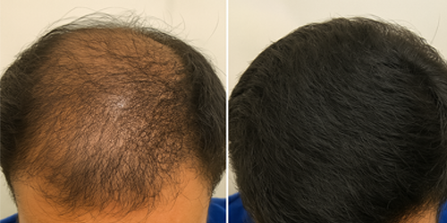 Before - Hair Transplant